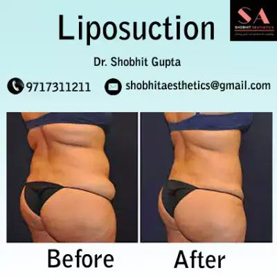 Get Tummy Tuck Surgery Cost in Delhi  Tummy Tuck Near Me - Dr. Shobhit  Gupta