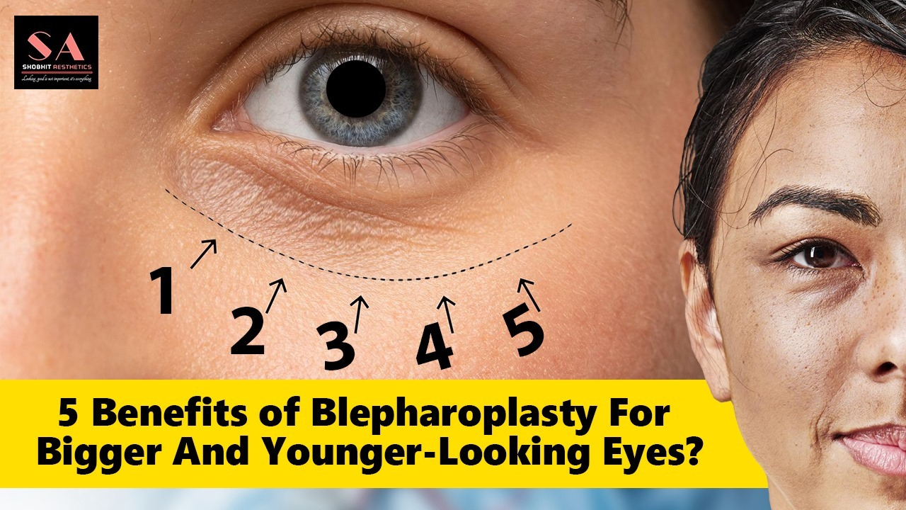 5 Benefits of Blepharoplasty for Bigger and Younger-Looking Eyes