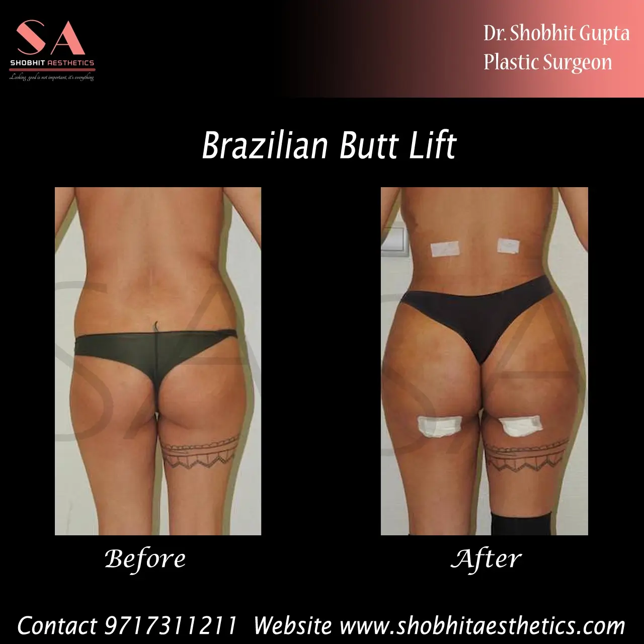 Before And After Bbl (Brazillian Butt Lift) Surgery Photos