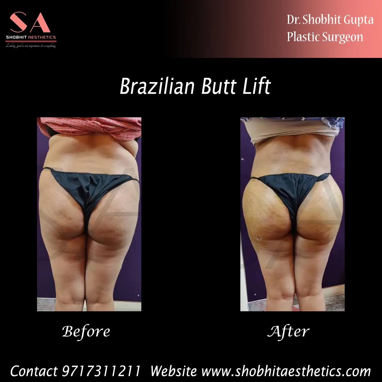 Post Op Recommendations for the Brazilian Butt Lift (BBL) - Marvel Cosmetic  Surgery