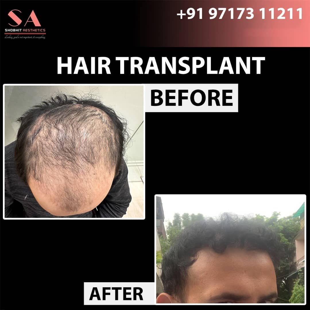 Before_After_Results_of_Hair_Transplant.jpeg