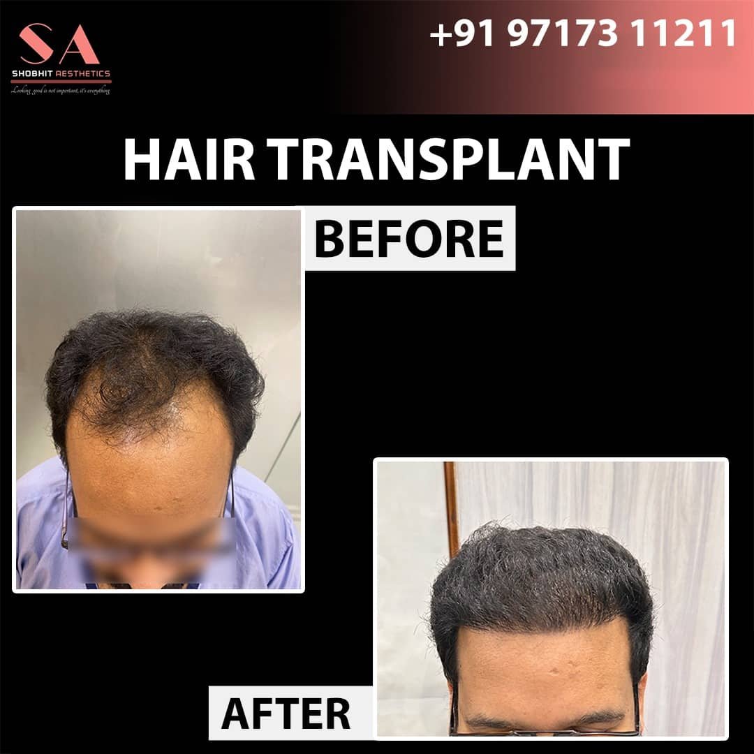Before_After_Results_of_Hair_Transplant_2.jpeg