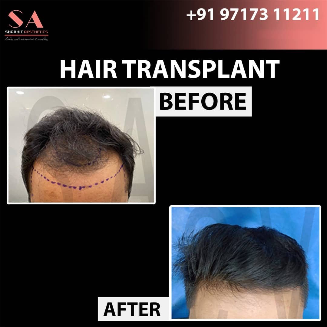 Before_After_Results_of_Hair_Transplant_3.jpeg