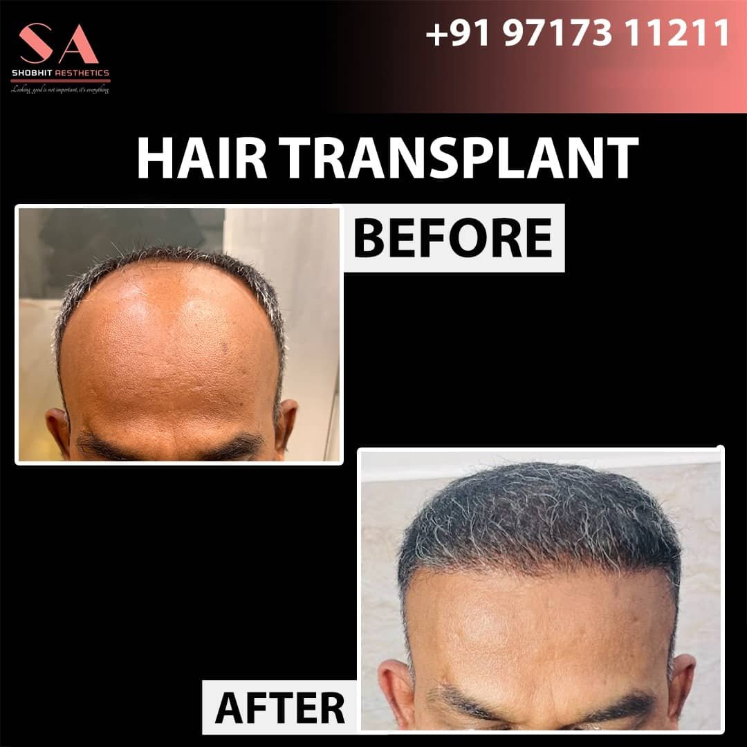 Before_After_Results_of_Hair_Transplant_4.jpeg