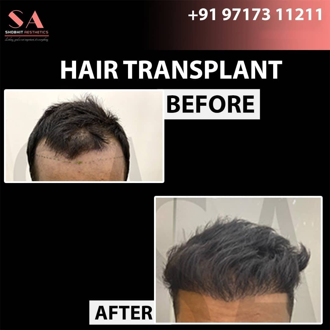 Before_After_Results_of_Hair_Transplant_5.jpeg