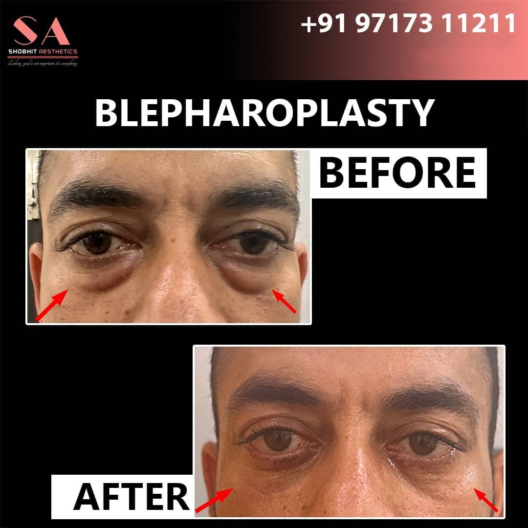Blepharoplasty_Surgery_Before_After_Results_10.jpeg