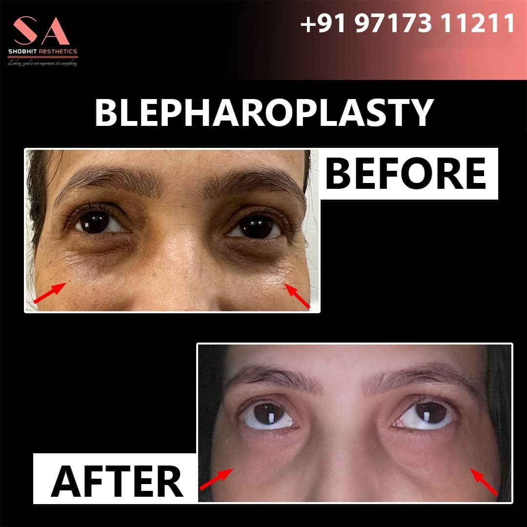 Blepharoplasty_Surgery_Before_After_Results_11.jpeg