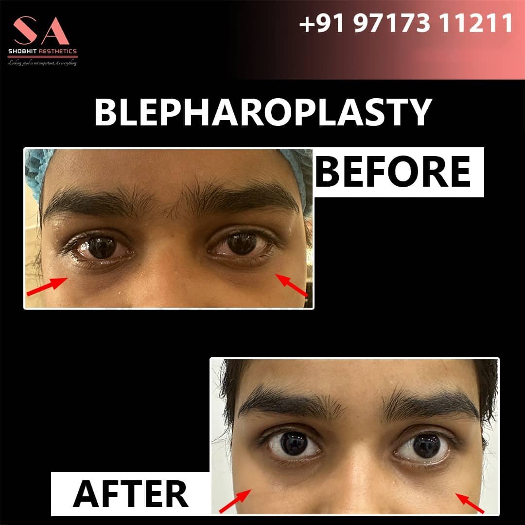 Blepharoplasty_Surgery_Before_After_Results_2.jpeg