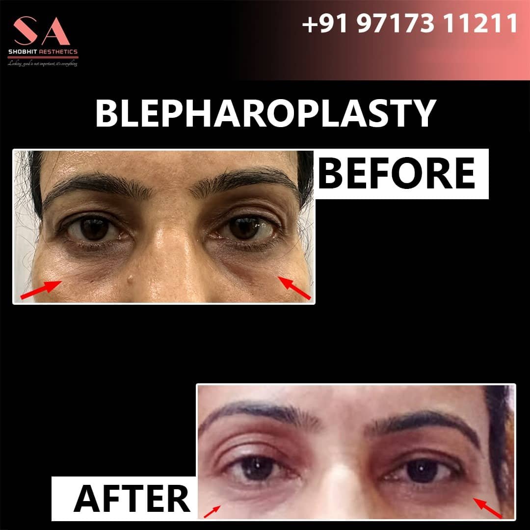 Blepharoplasty_Surgery_Before_After_Results_4.jpeg