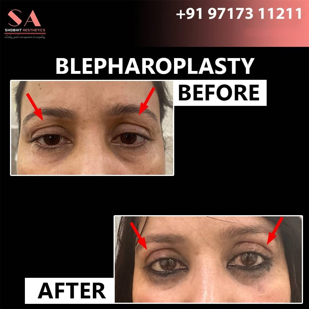 Blepharoplasty_Surgery_Before_After_Results_5.jpeg