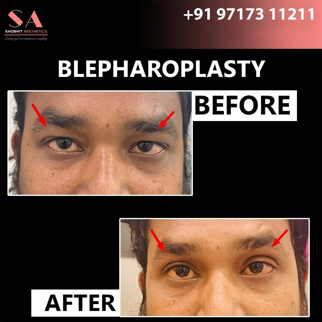 Blepharoplasty_Surgery_Before_After_Results_6.jpeg