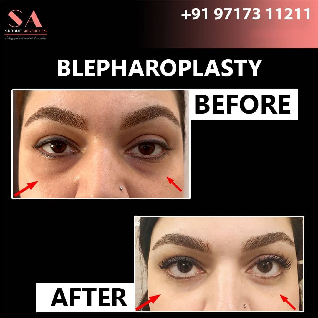 Blepharoplasty_Surgery_Before_After_Results_7.jpeg