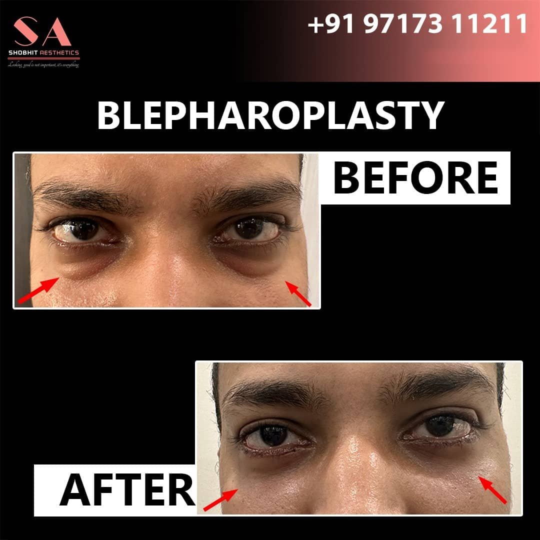 Blepharoplasty_Surgery_Before_After_Results_8.jpeg