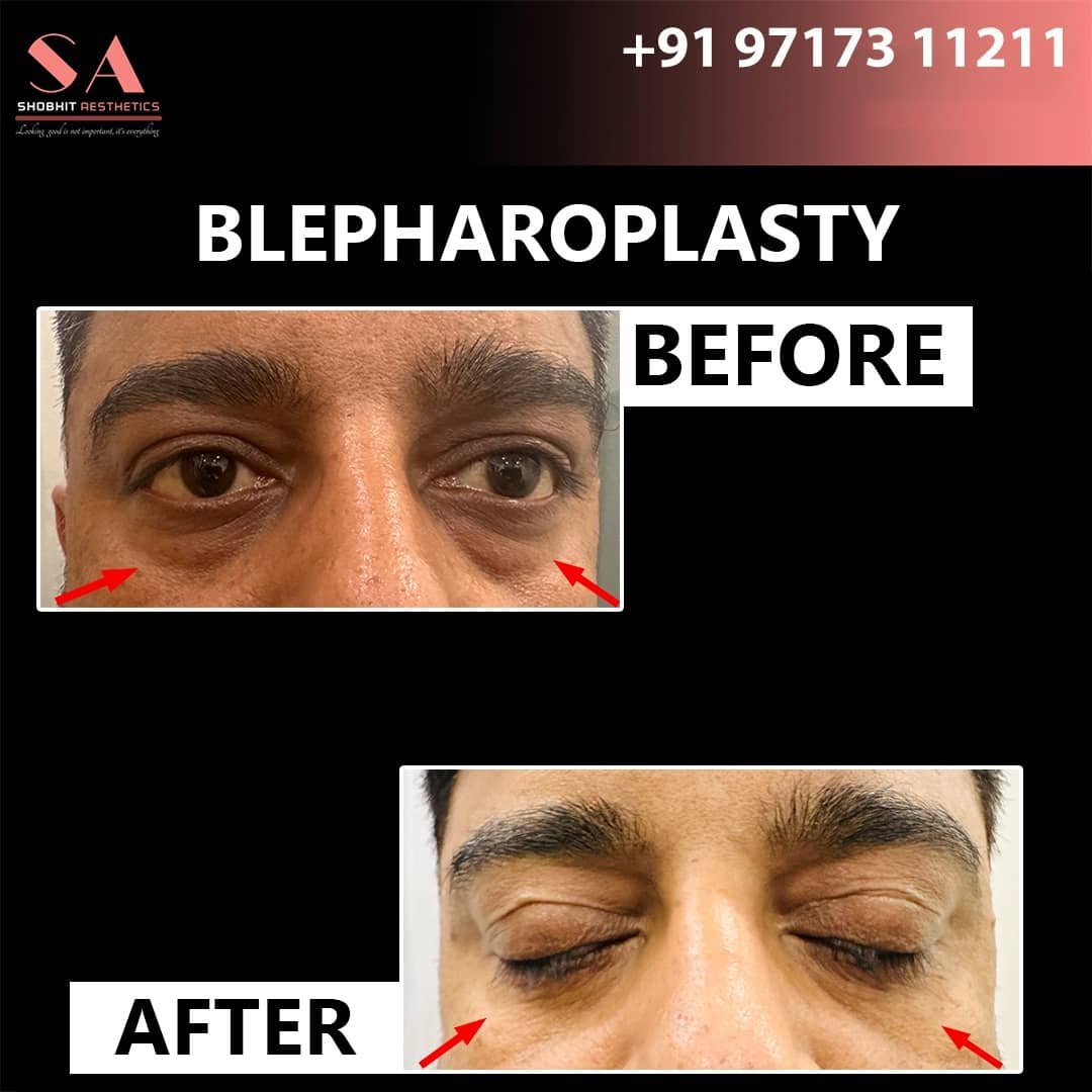 Blepharoplasty_Surgery_Before_After_Results_9.jpeg