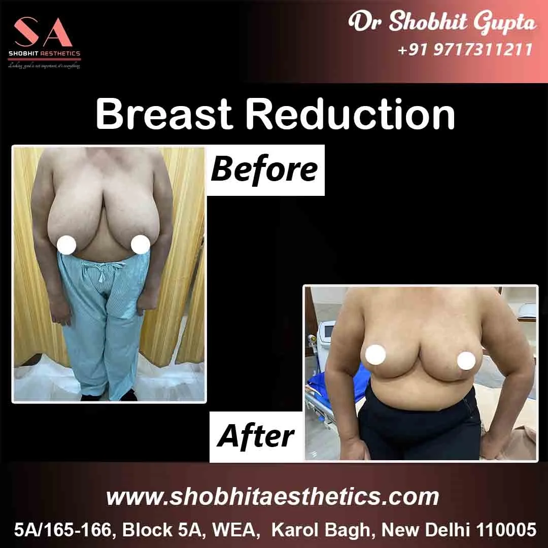 Breast_Reduction_Before_After1.webp