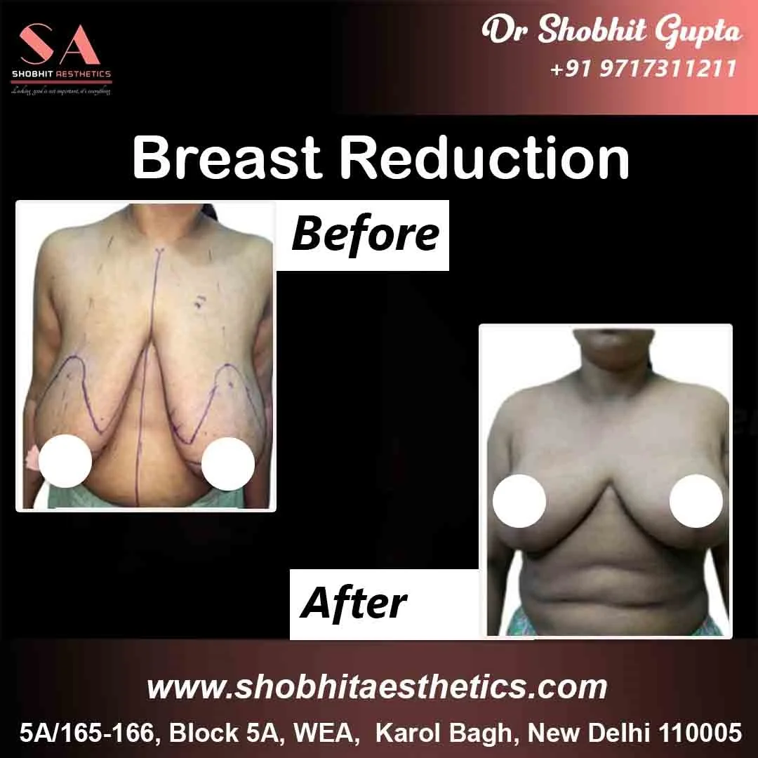 Breast Reduction in Mumbai