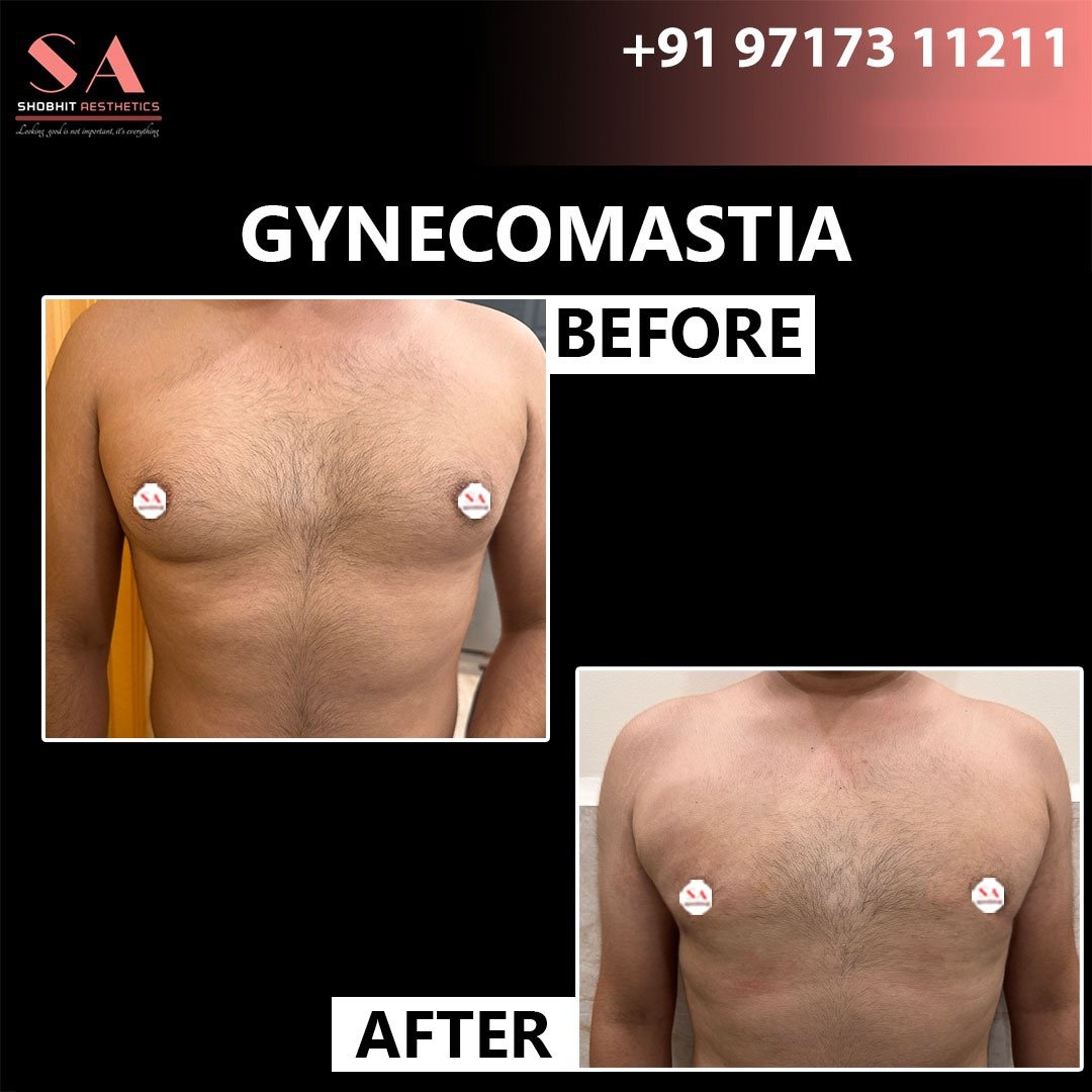 Gynaecomastia_Treatment_Before_After_Results.jpeg