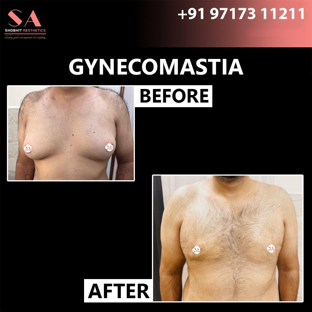 Gynaecomastia_Treatment_Before_After_Results_1.jpeg