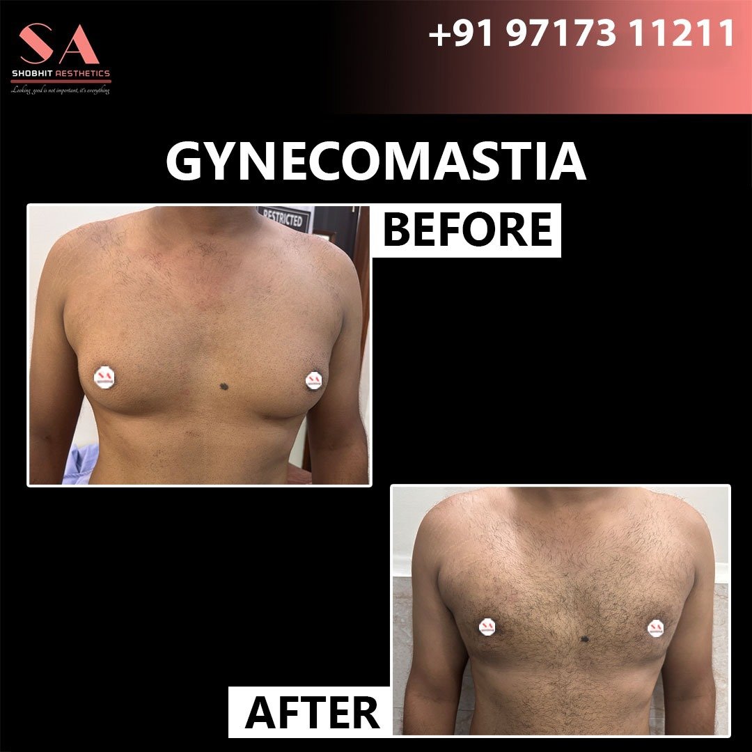Gynaecomastia_Treatment_Before_After_Results_2.jpeg