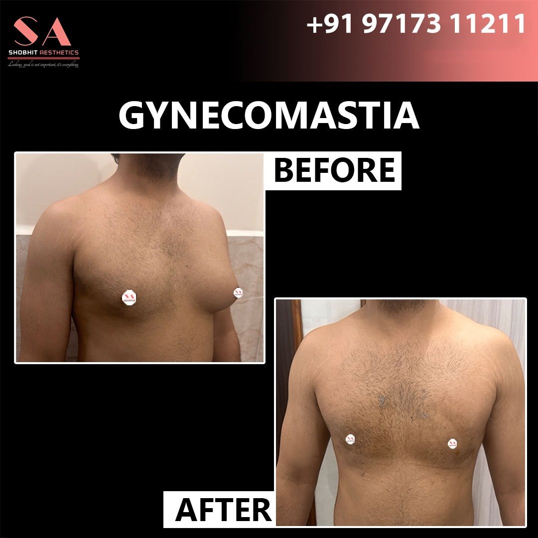 Gynaecomastia_Treatment_Before_After_Results_3.jpeg