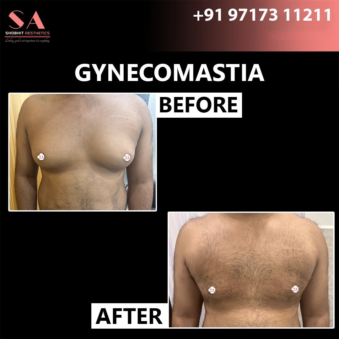 Gynaecomastia_Treatment_Before_After_Results_4.jpeg