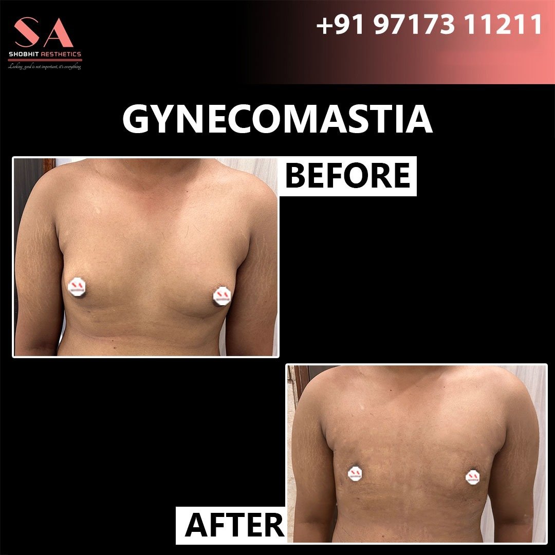 Gyne_Treatment_Before_After_Results_1.jpeg