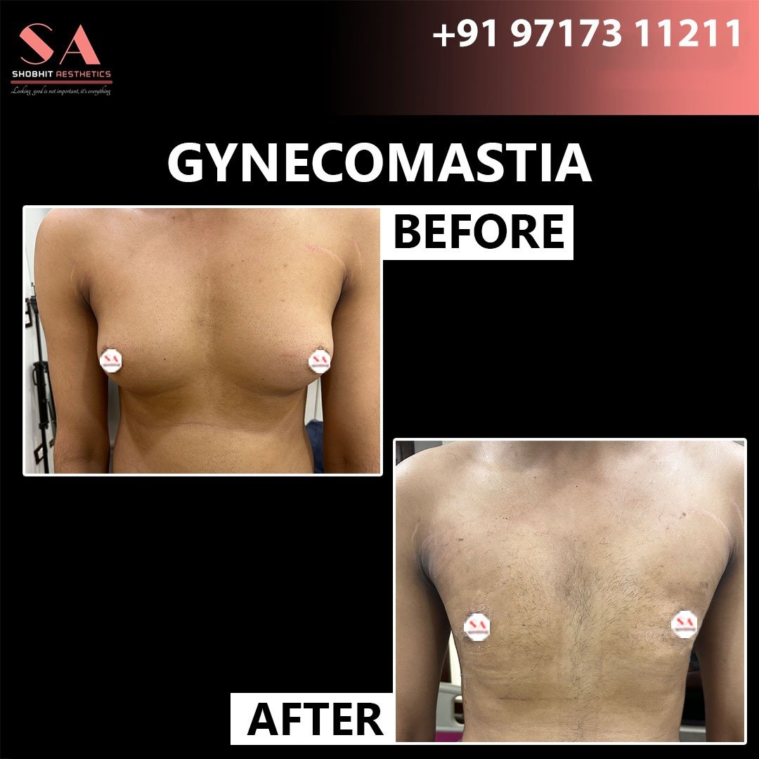 Gyne_Treatment_Before_After_Results_2.jpeg