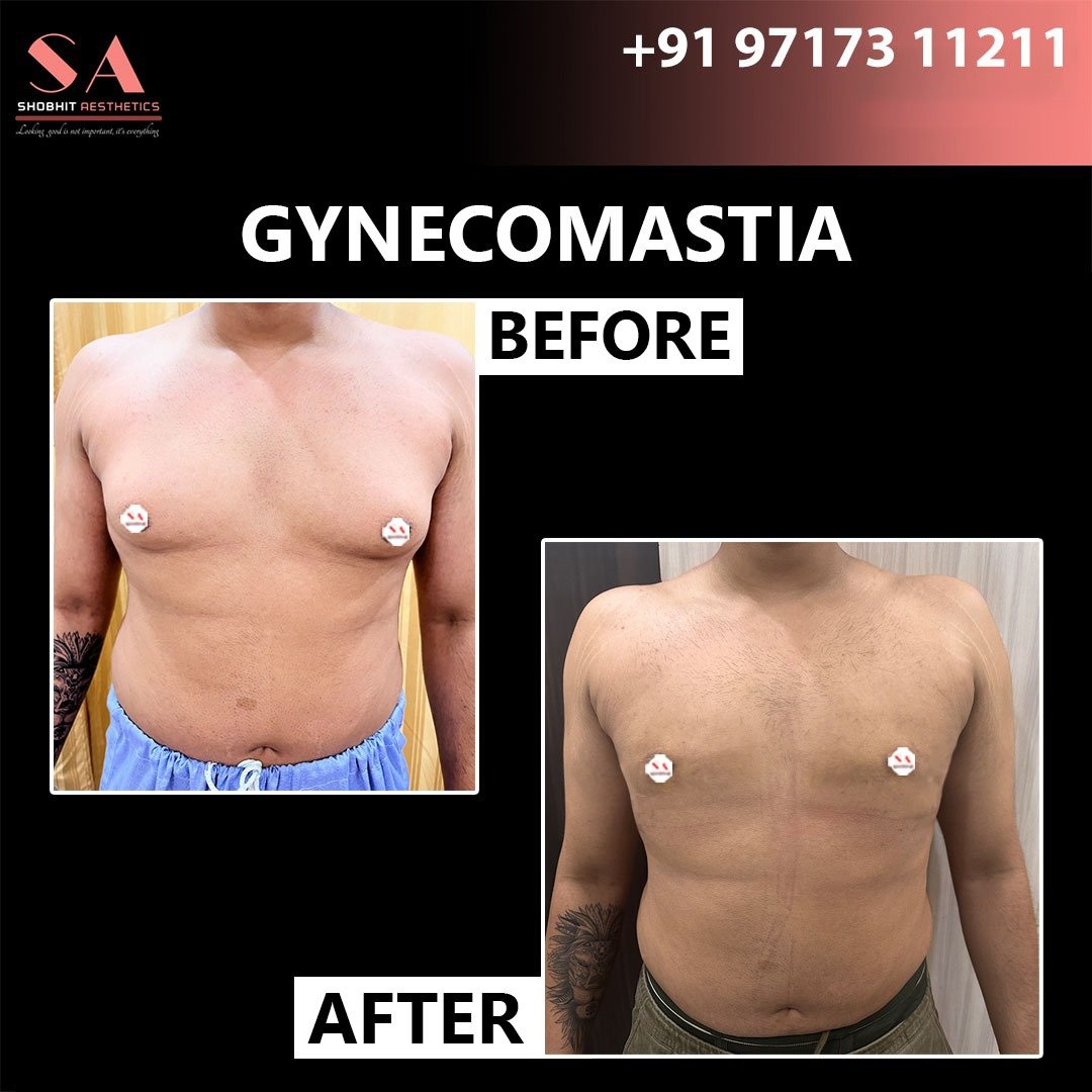 Gyne_Treatment_Before_After_Results_3.jpeg