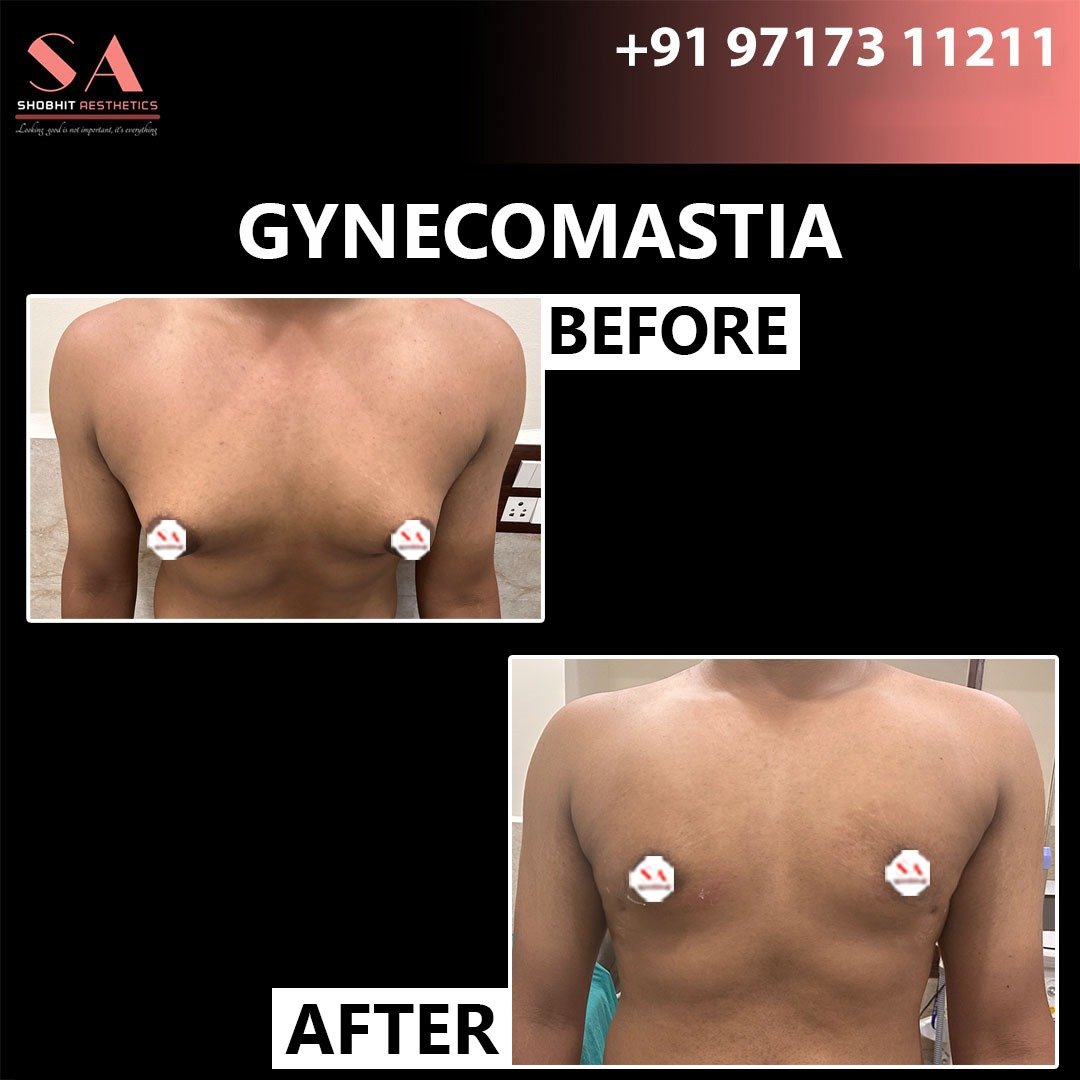 Gyne_Treatment_Before_After_Results_4.jpeg
