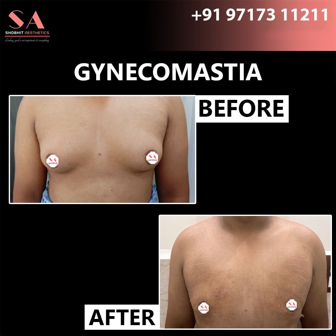 Gyne_Treatment_Before_After_Results_6.jpeg