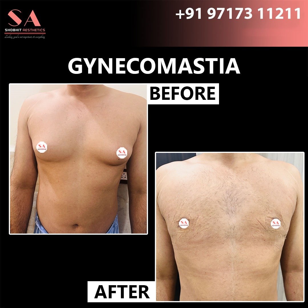 Gyne_Treatment_Before_After_Results_8.jpeg