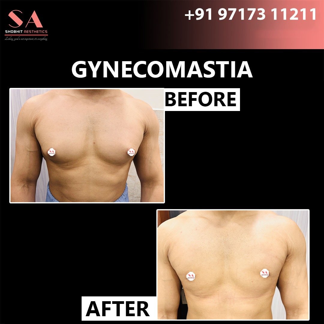 Gyne_Treatment_Before_After_Results_9.jpeg