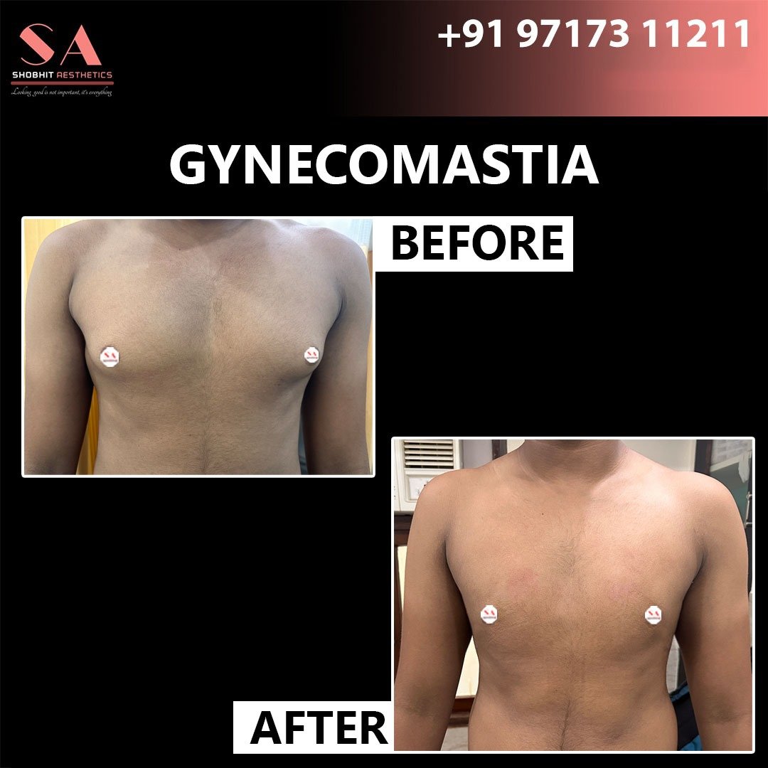 Gynecomastia in Sonipat