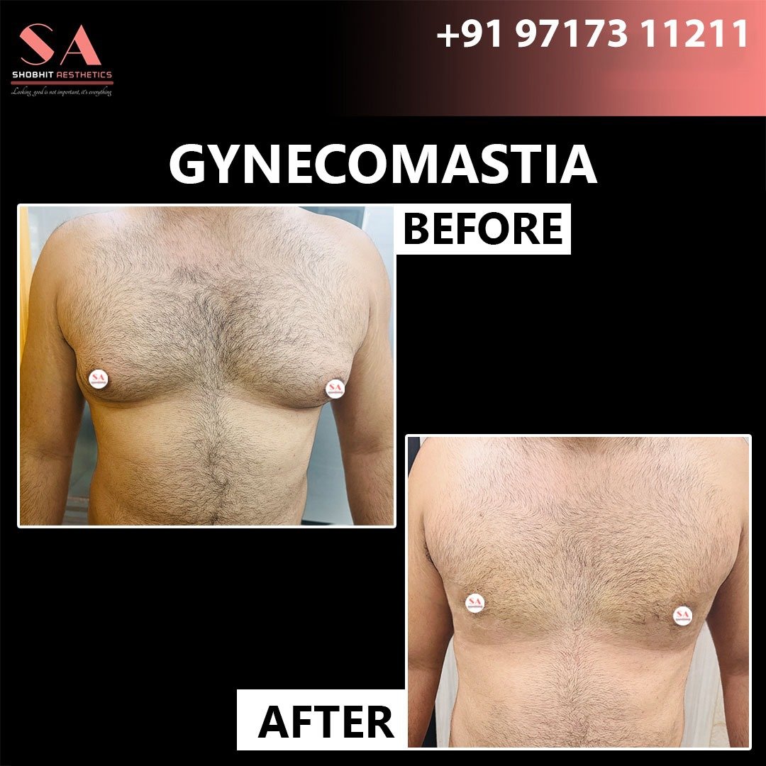 Gynecomastia in Noida
