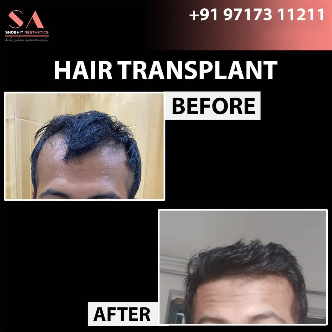 Hair_Transplant_Before_After_Results_1.jpeg
