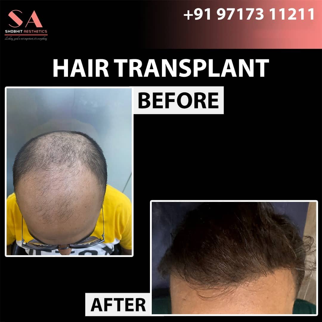Hair Transplant in Chandigarh
