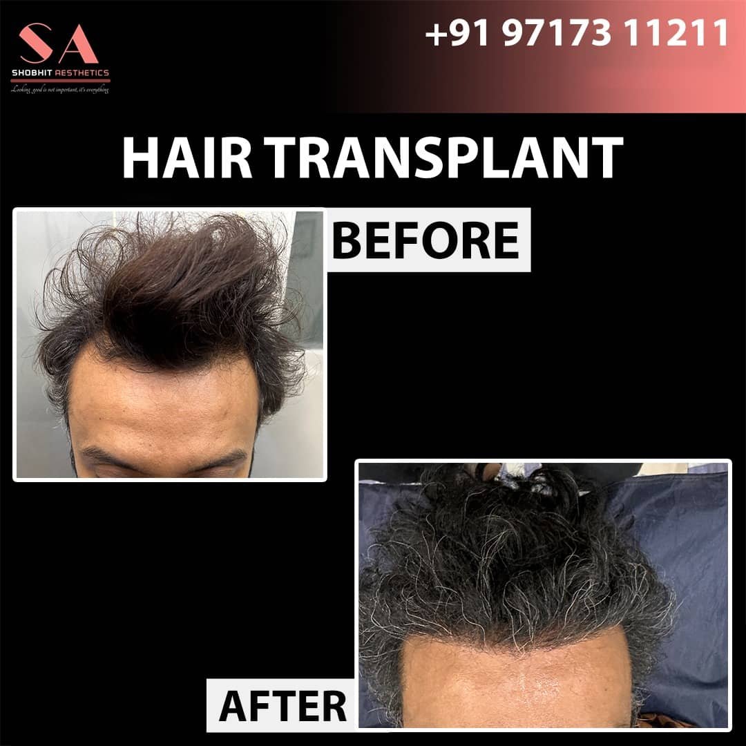 Hair Transplant in Jaipur