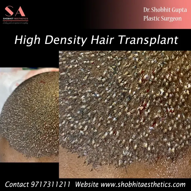 High-density-hair-transplant-1.webp