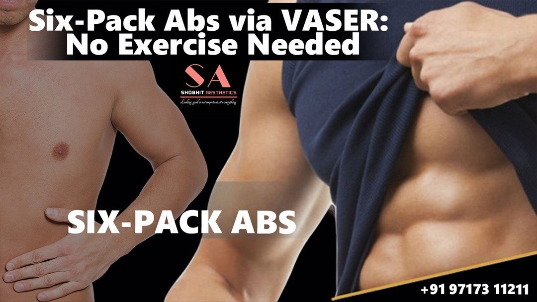 Six-Pack Abs via VASER: No Exercise Needed