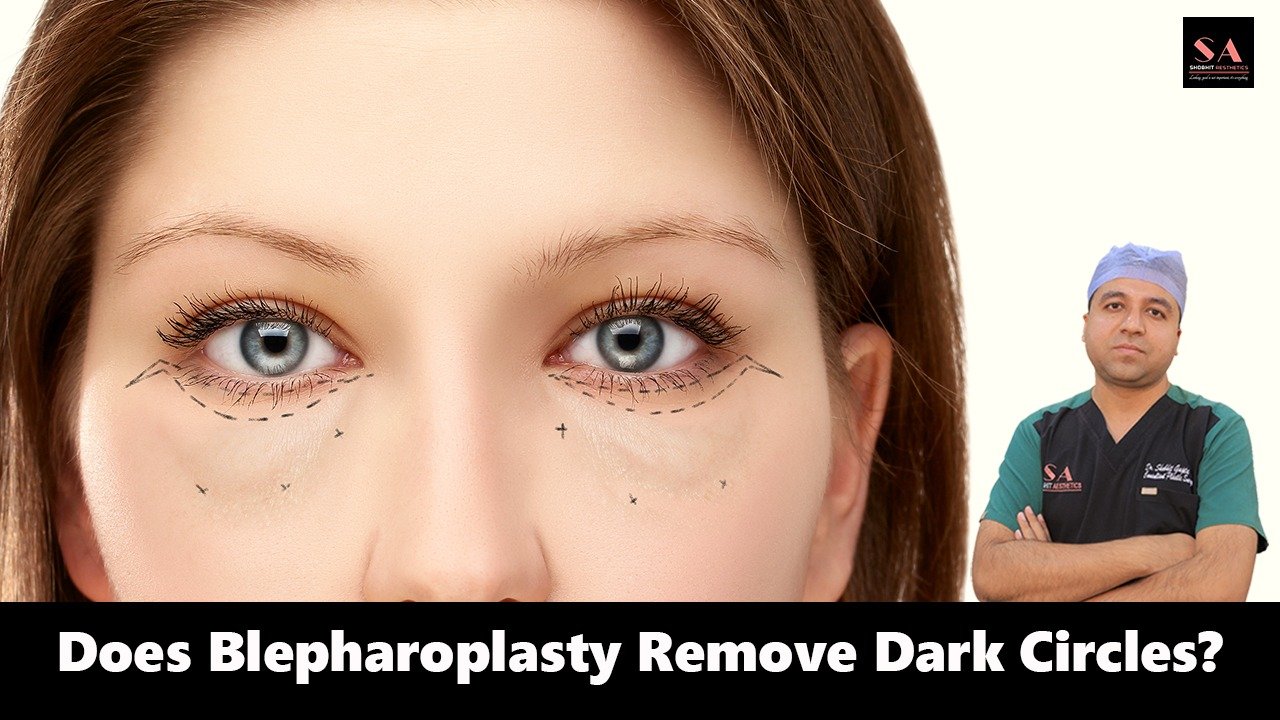 Does Blepharoplasty Remove Dark Circles?