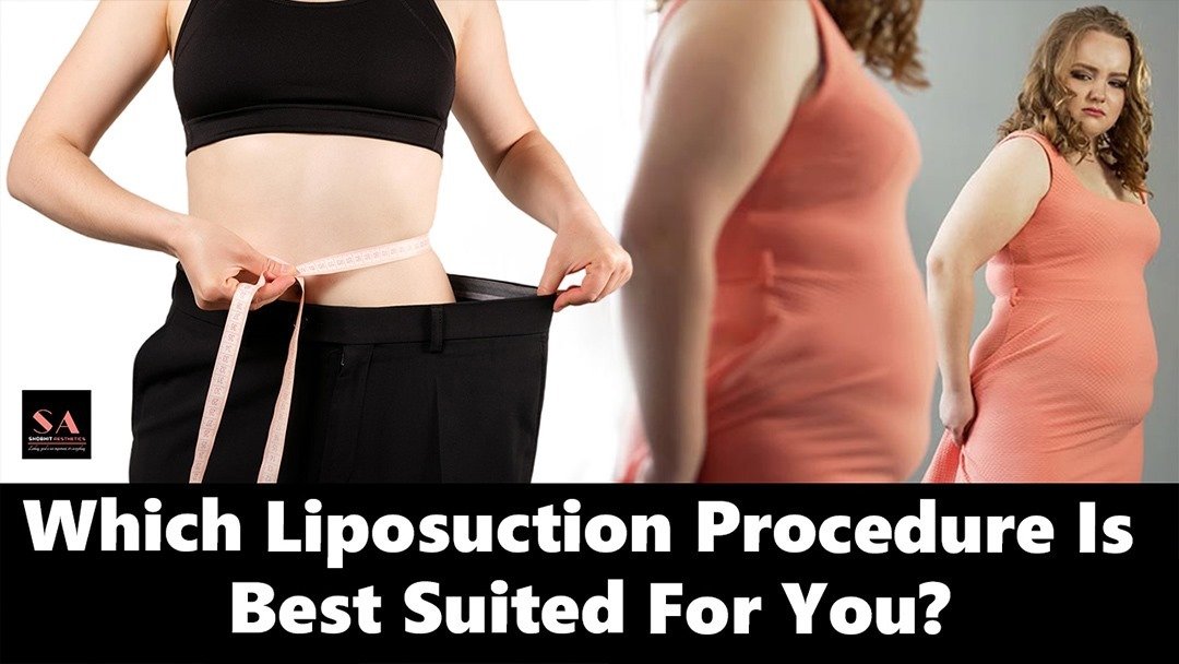 Which Liposuction Procedure Is Best Suited For You?