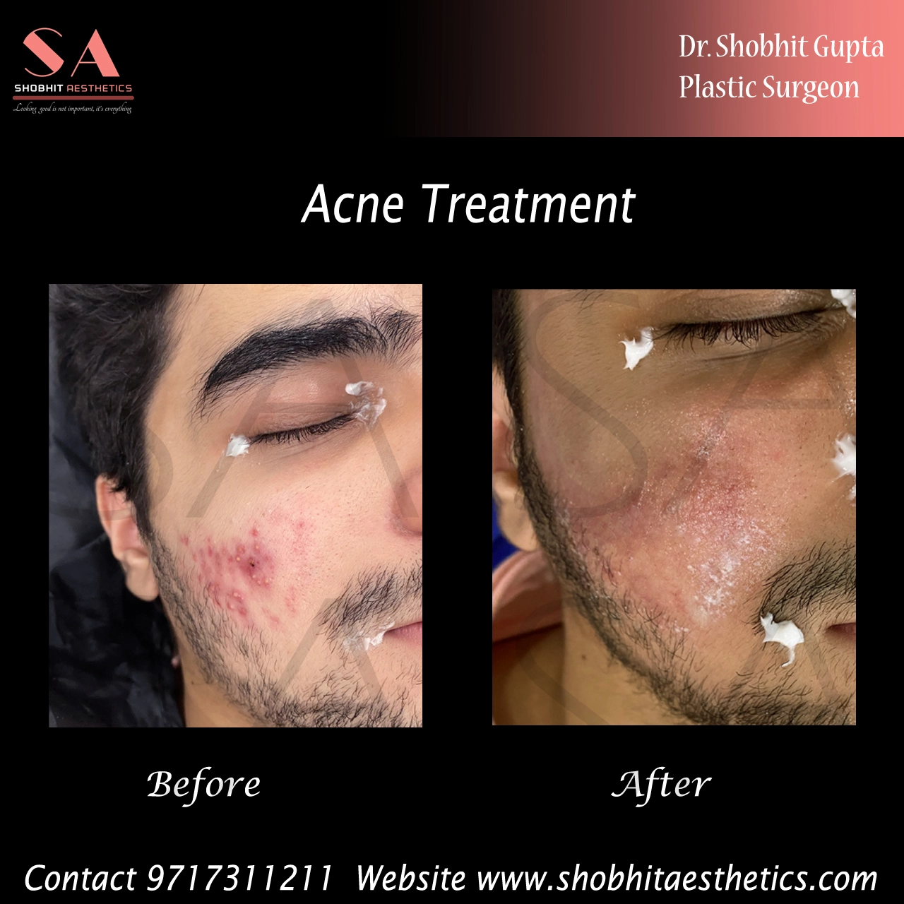 scar-removal-surgery-cost-in-delhi-scar-revision-treatment