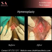 Hymenoplasty
