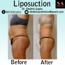 liposuction-001.webp