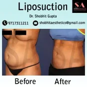 liposuction-edit1.webp