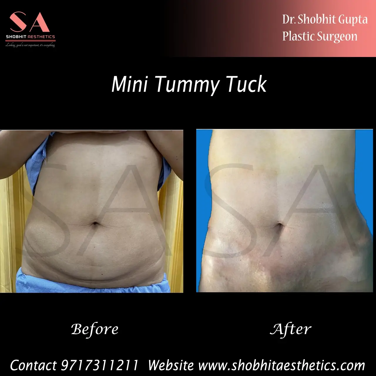 Abdominoplasty (Tummy Tuck) - Body Procedure at best price in Lucknow