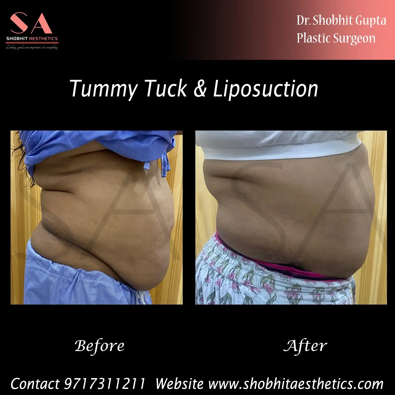 Tummy Tuck in Ahmedabad
